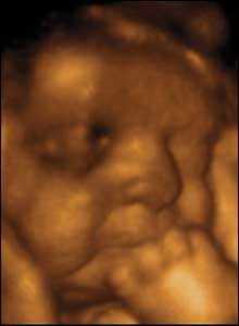 photo9__3d_ultrasound_in_the_womb